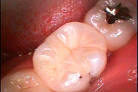 銀歯を白く画像・術後